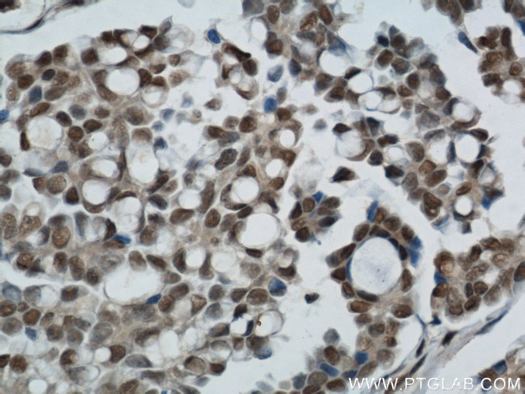 IHC of paraffin-embedded human ovary tumor using 10201-2-AP (ubiquitin antibody) at dilution of 1:50 (under 40x lens)