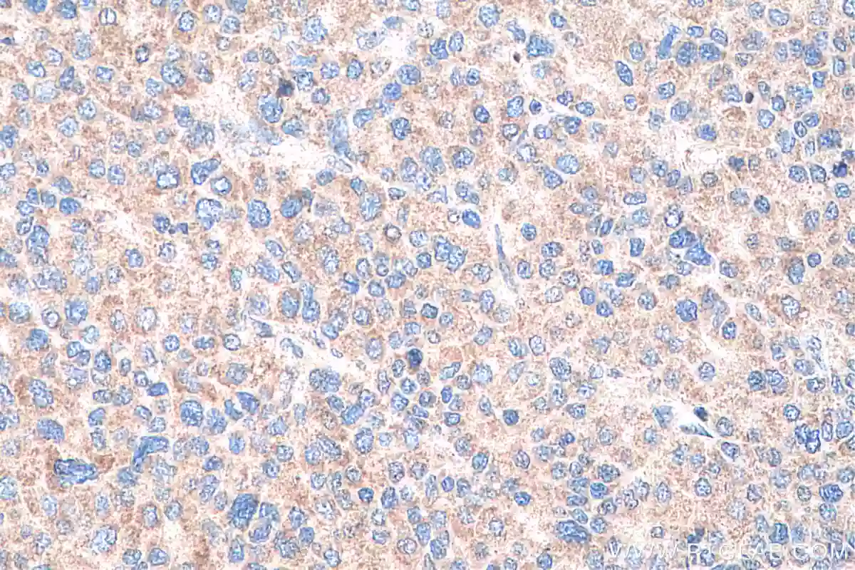 Immunohistochemical analysis of paraffin-embedded human liver cancer tissue slide using Glypican 3 antibody