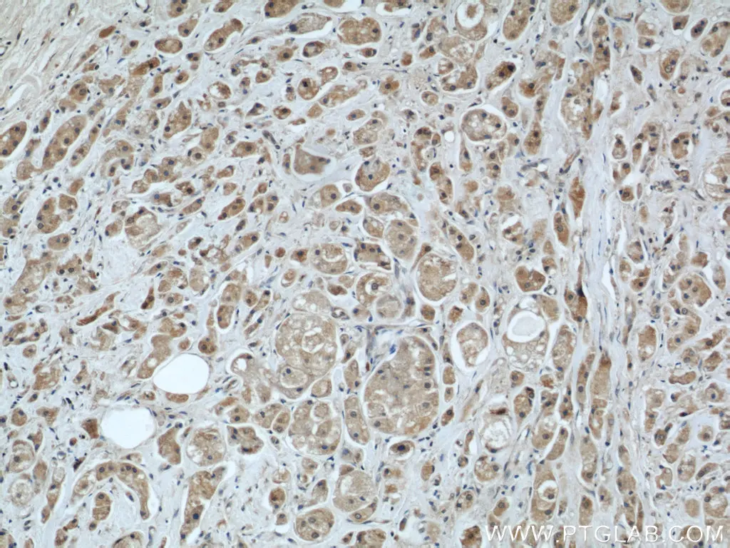 Immunohistochemical analysis of paraffin-embedded human breast cancer using MRPS18B antibody
