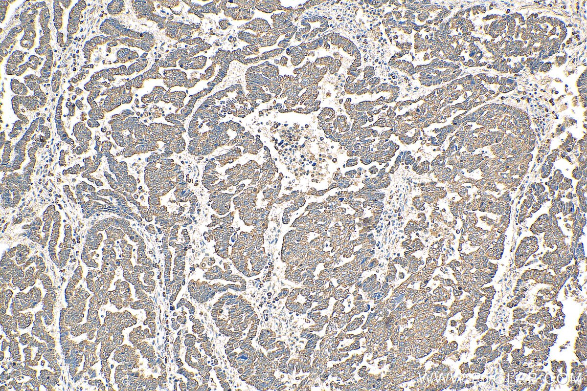 AKT Antibody IHC human ovary tumor tissue 10176-2-AP