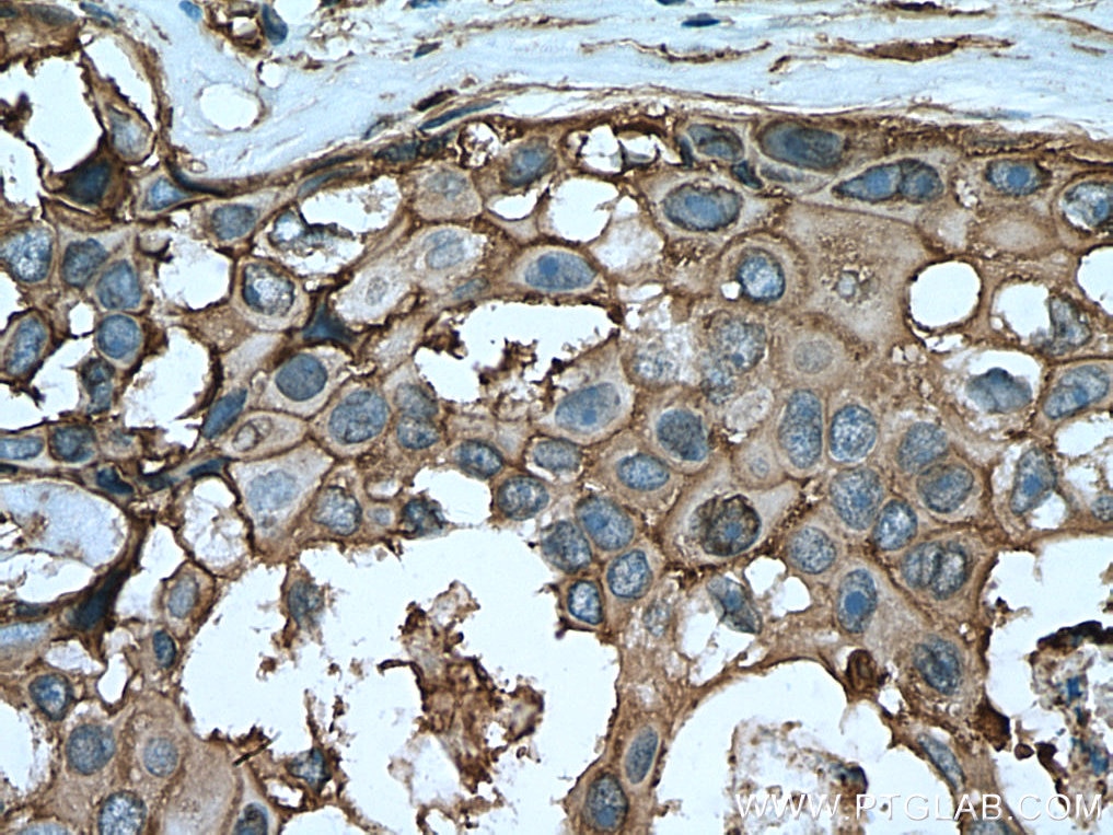 Annexin A2 Antibody IHC human breast cancer tissue 11256-1-AP