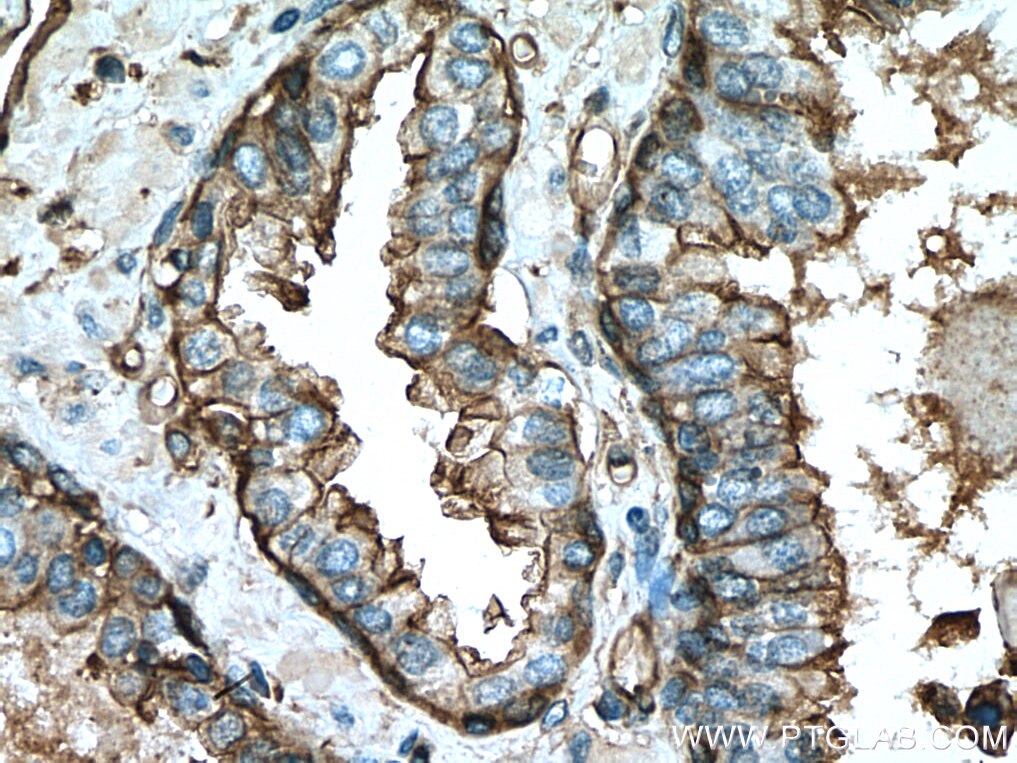 Annexin A2 Antibody IHC human prostate cancer tissue 11256-1-AP