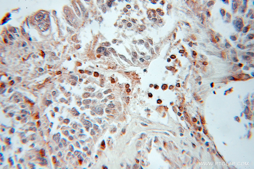 IHC analysis of paraffin-embedded human ovary tumour using GABARAPL1-Specific antibody (ATG8L, 11010-1-AP) 1:50, 40x) at dilution of 1:50; under 10x.