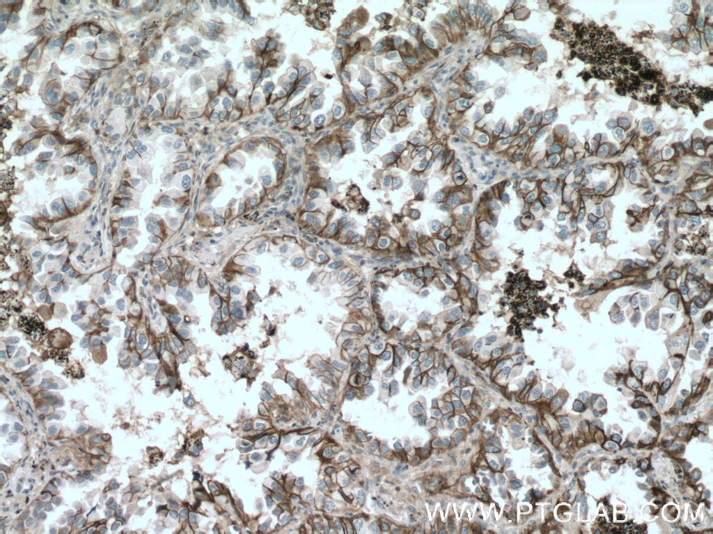 CD147 Antibody IHC human lung cancer tissue 11989-1-AP