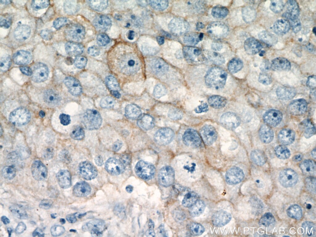 CD147 Antibody IHC human breast cancer tissue 11989-1-AP