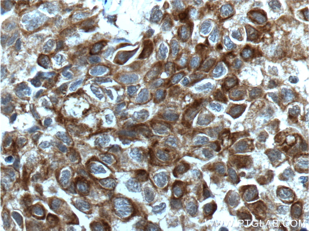 Bcl-XL Antibody IHC human lung cancer tissue 10783-1-AP