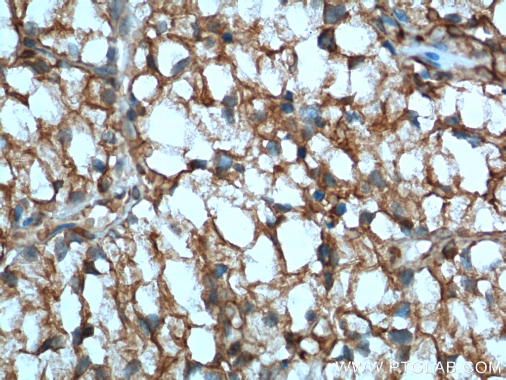 Immunohistochemical staining of paraffin-embedded human renal cell carcinoma tissue using CA9 antibody (66243-1-IG) at a dilution of 1:400 (40x objective). Heat-mediated antigen retrieved with Tris-EDTA buffer (pH9)
