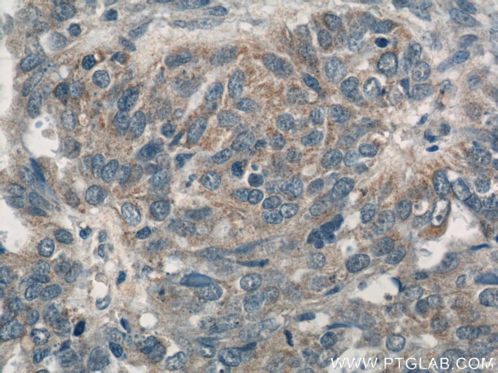 NDP52 Antibody IHC human ovary tumor tissue 12229-1-AP