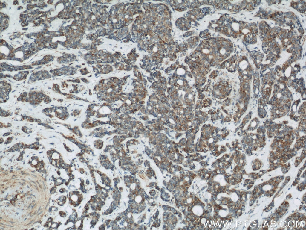 Calnexin Antibody IHC human cervical cancer tissue 10427-2-AP