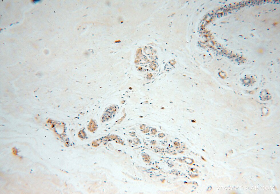 CAPZA2 Antibody IHC human colon cancer tissue 15948-1-AP