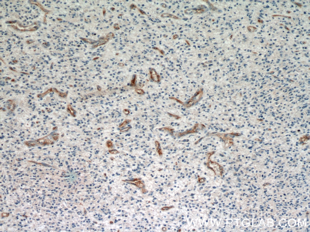 CD34 Antibody IHC human gliomas tissue 14486-1-AP