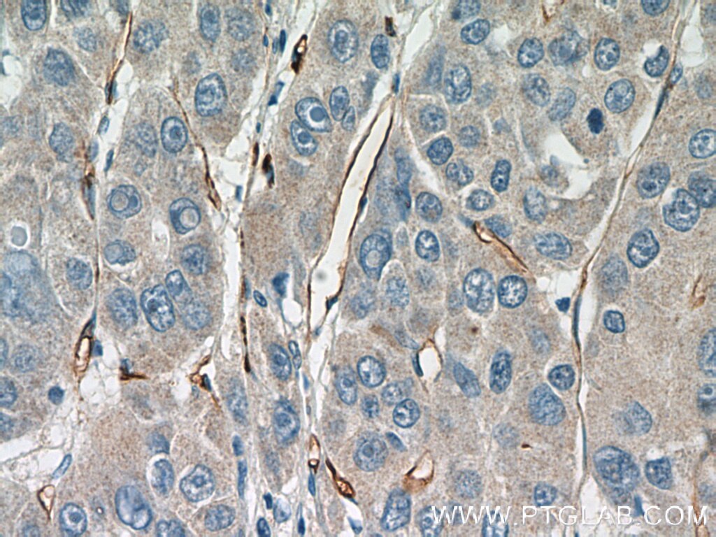 CD34 Antibody IHC human liver cancer tissue 14486-1-AP