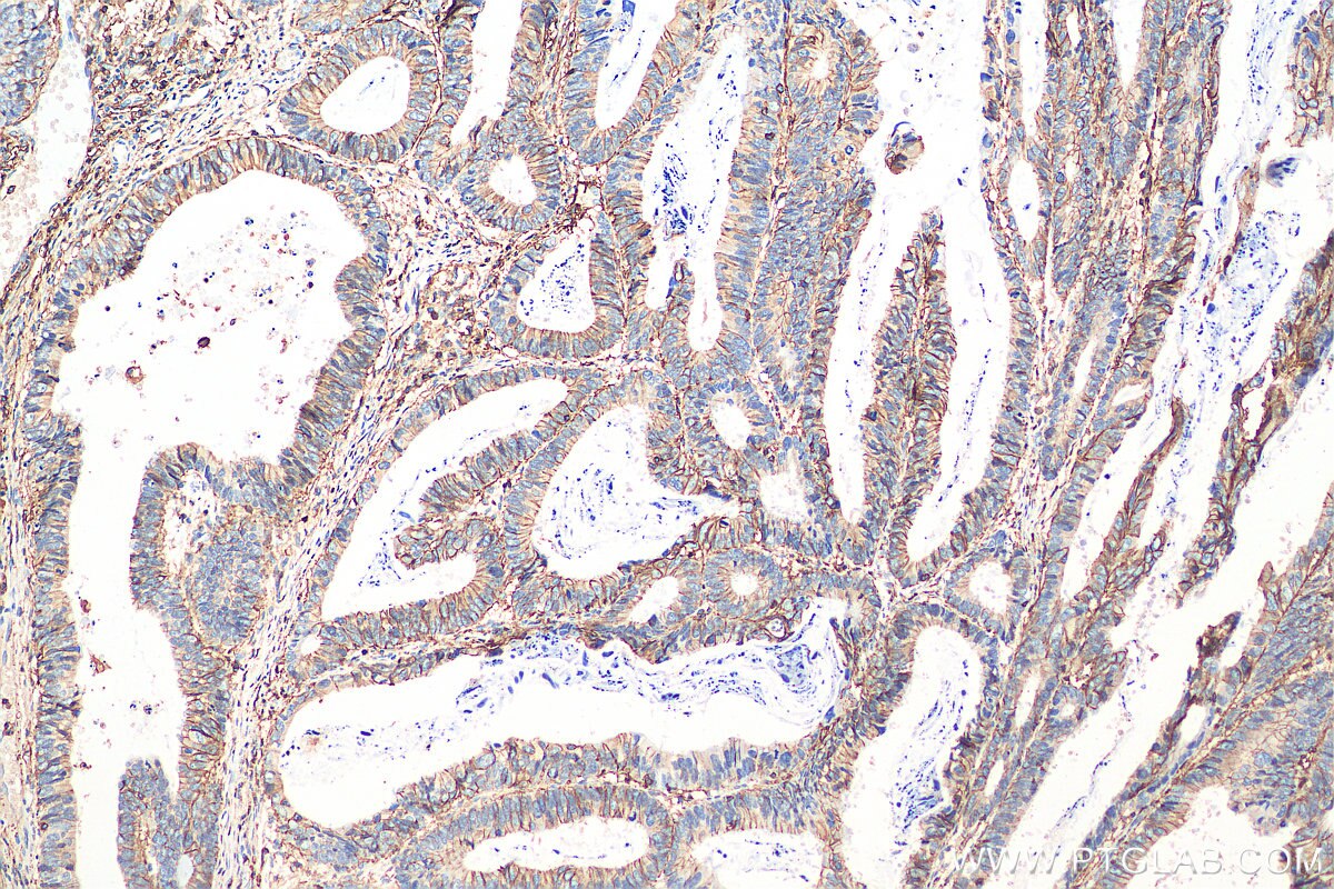 Can You Survive Stage 4 Lung And Brain Cancer