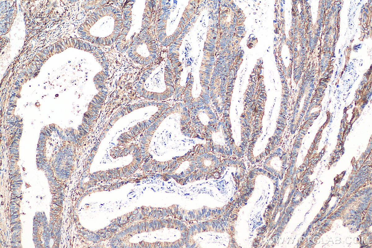 peritoneal mesothelioma gender