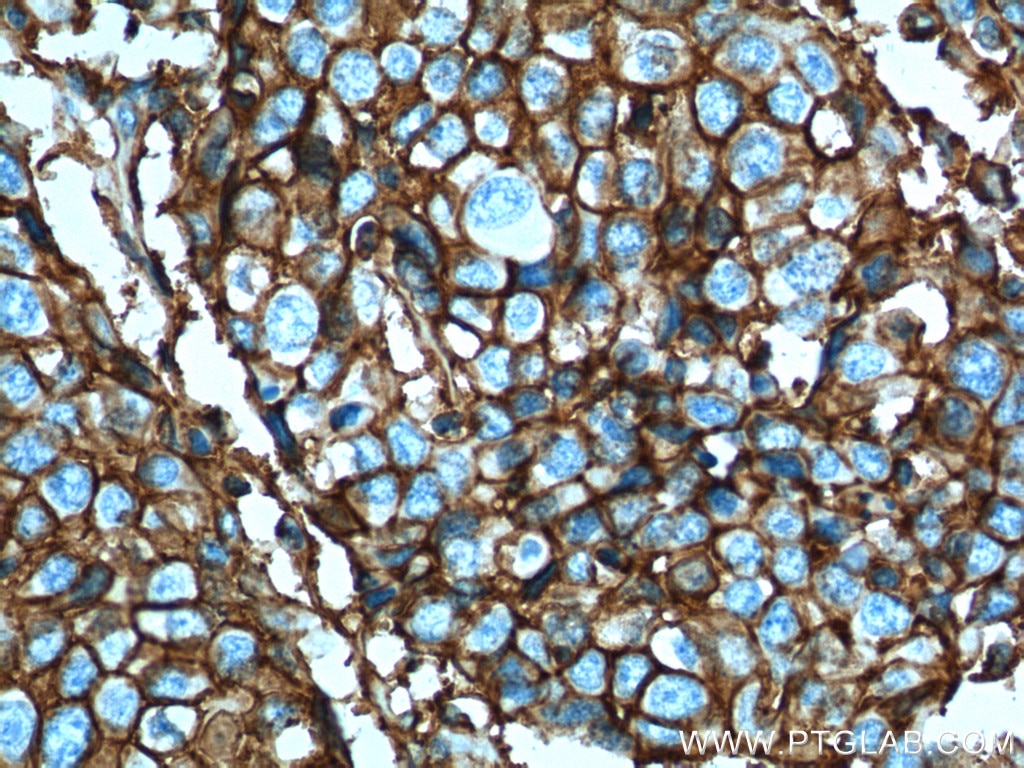 CD44 Antibody IHC human lung cancer tissue 15675-1-AP
