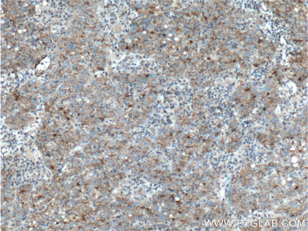 Clusterin Antibody IHC human liver cancer tissue 12289-1-AP
