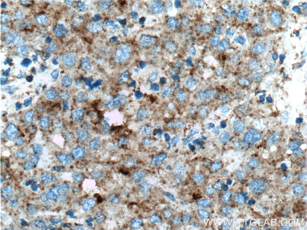 Clusterin Antibody IHC human liver cancer tissue 12289-1-AP