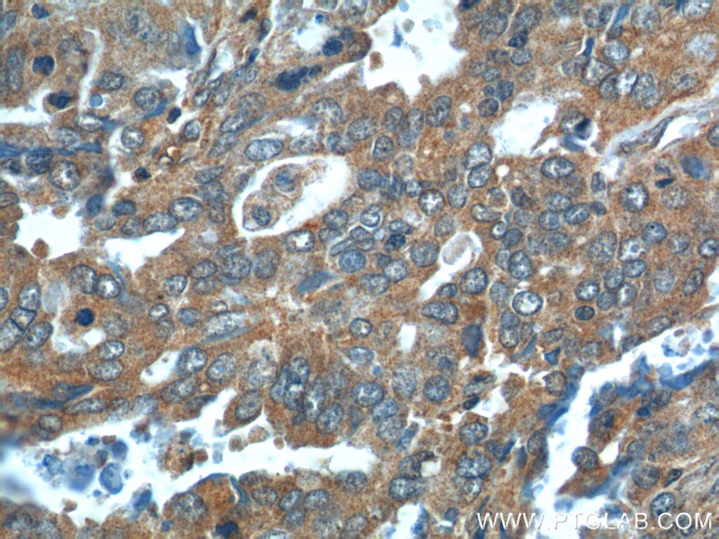 Cathepsin B Antibody IHC human ovary tumor tissue 12216-1-AP