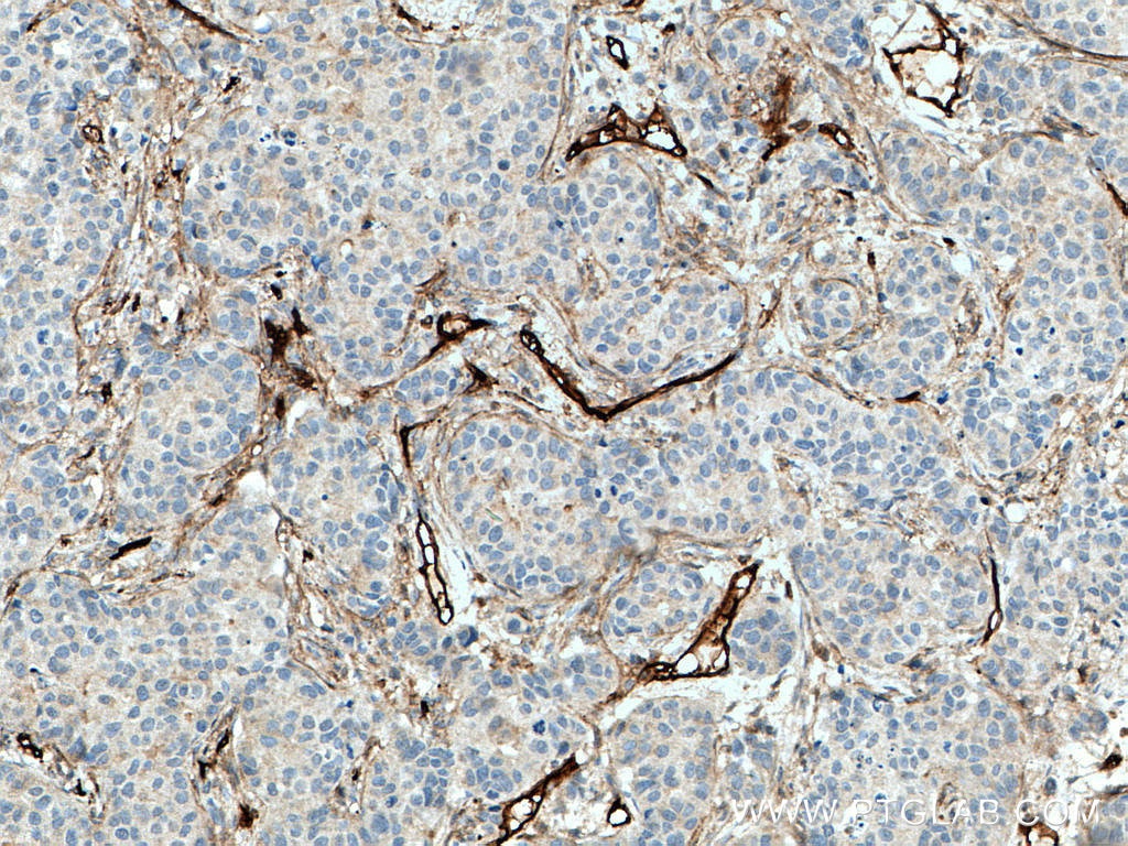 Endoglin/CD105 Antibody IHC human breast cancer tissue 28117-1-AP