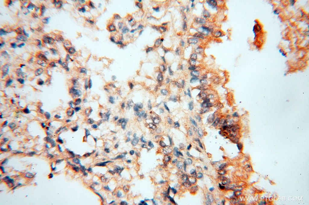 NSE Antibody IHC human lung tissue 10149-1-AP
