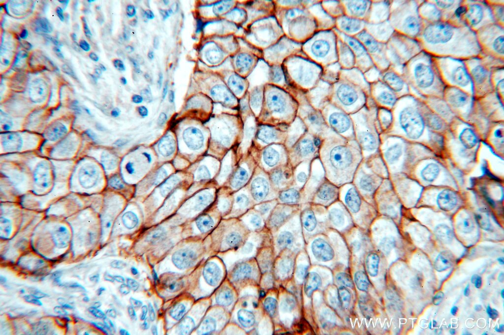 IHC staining of paraffin-embedded human breast cancer using HER2/ErbB2 antibody (51105-1-AP) at a dilution of 1:50 (40x objective)