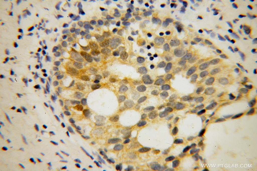 IHC of paraffin-embedded human gliomas using 13755-1-AP FMR1 antibody at dilution of 1:100 (under 40x lens)