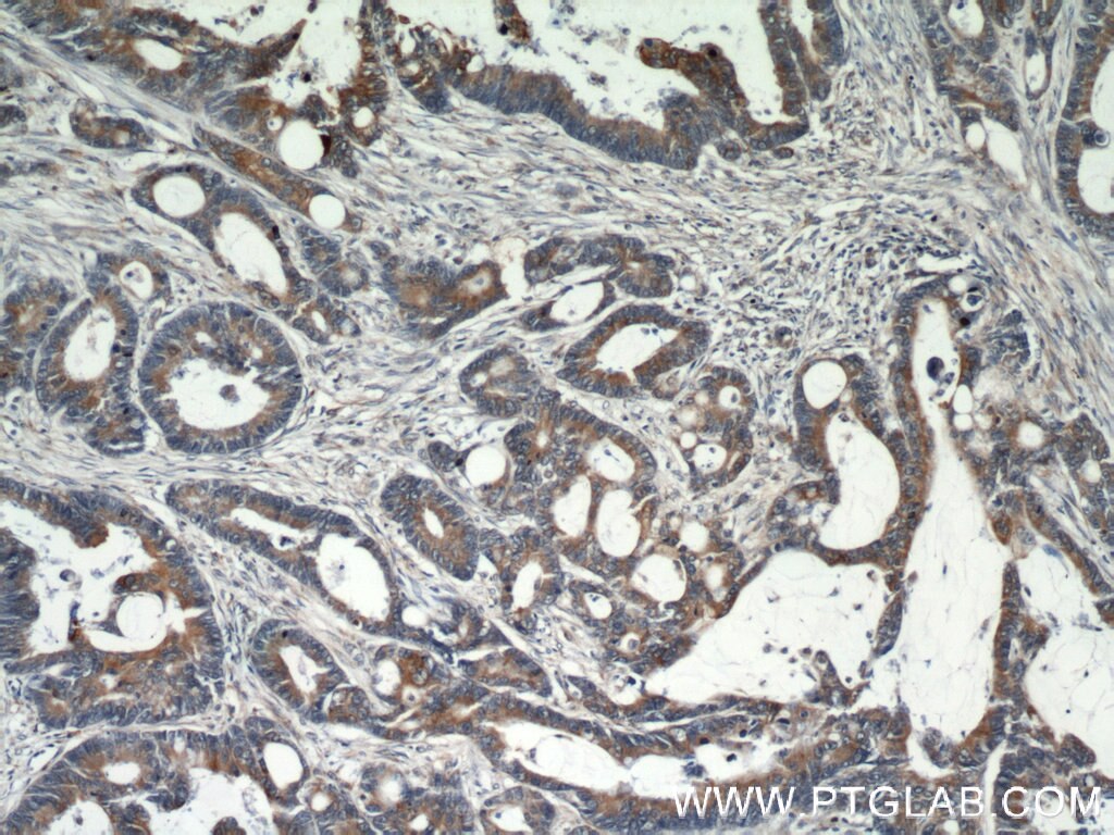 GRP78/BIP Antibody IHC human colon cancer tissue 11587-1-AP
