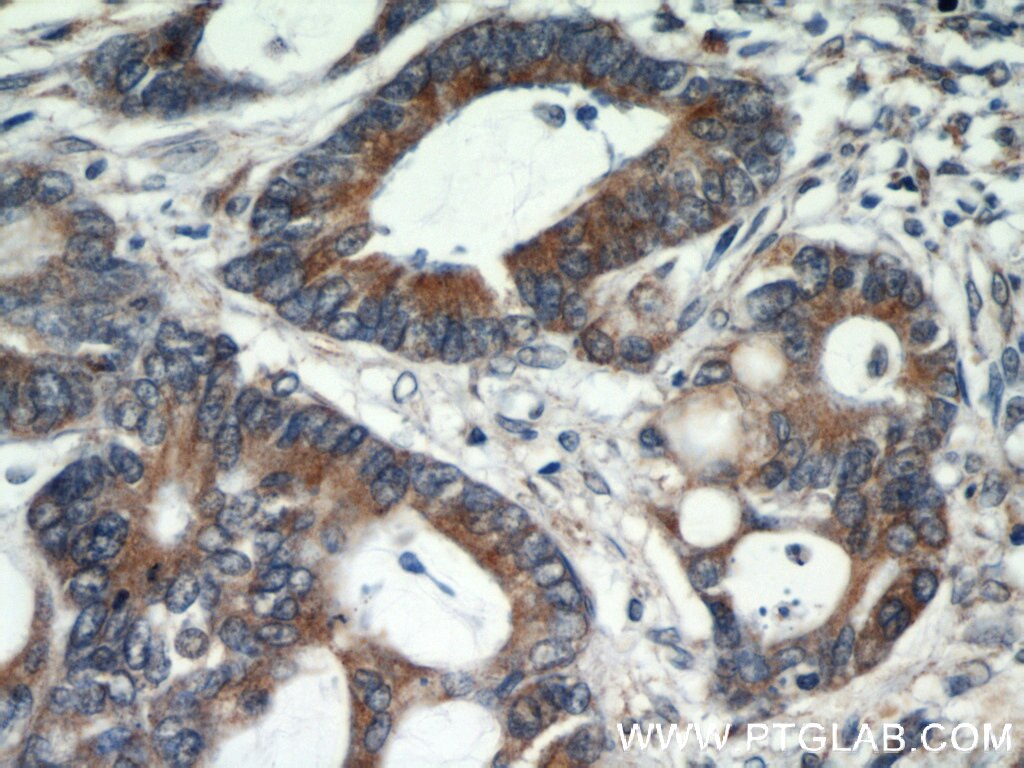 GRP78/BIP Antibody IHC human colon cancer tissue 11587-1-AP