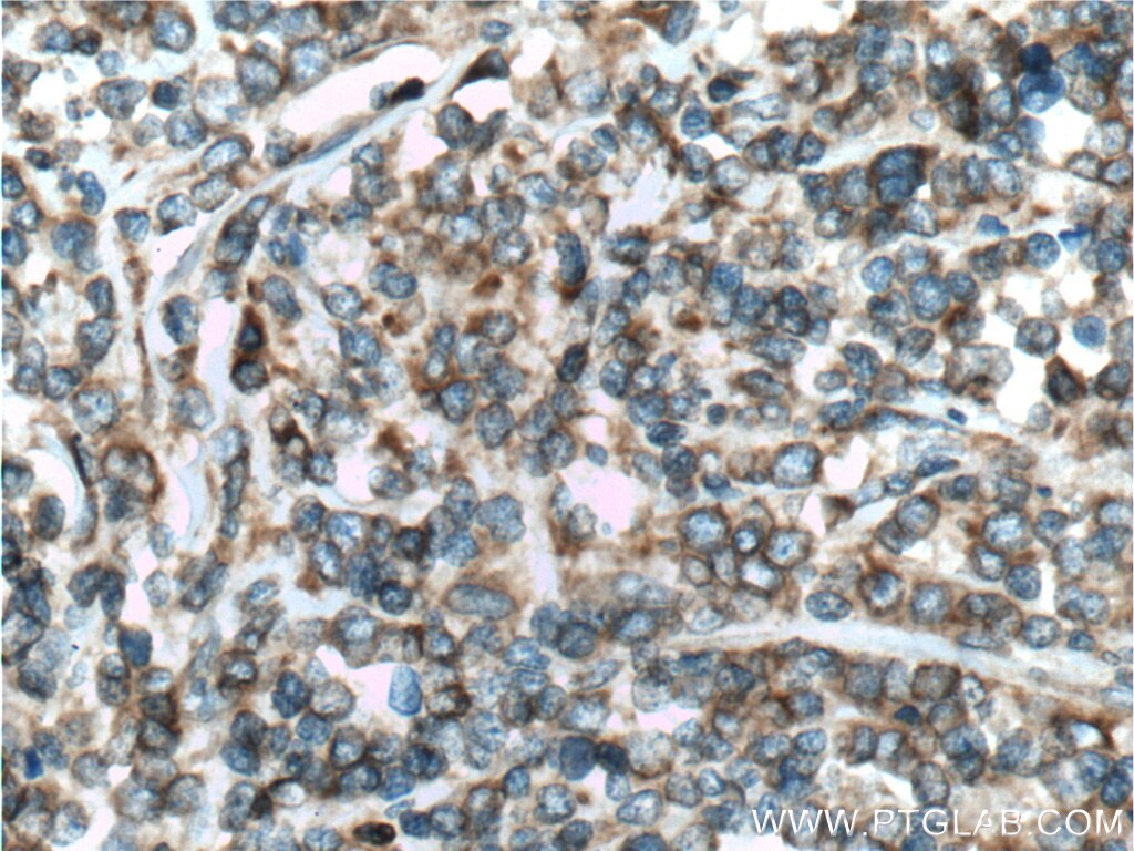 HMOX2 Antibody IHC human lymphoma tissue 14817-1-AP