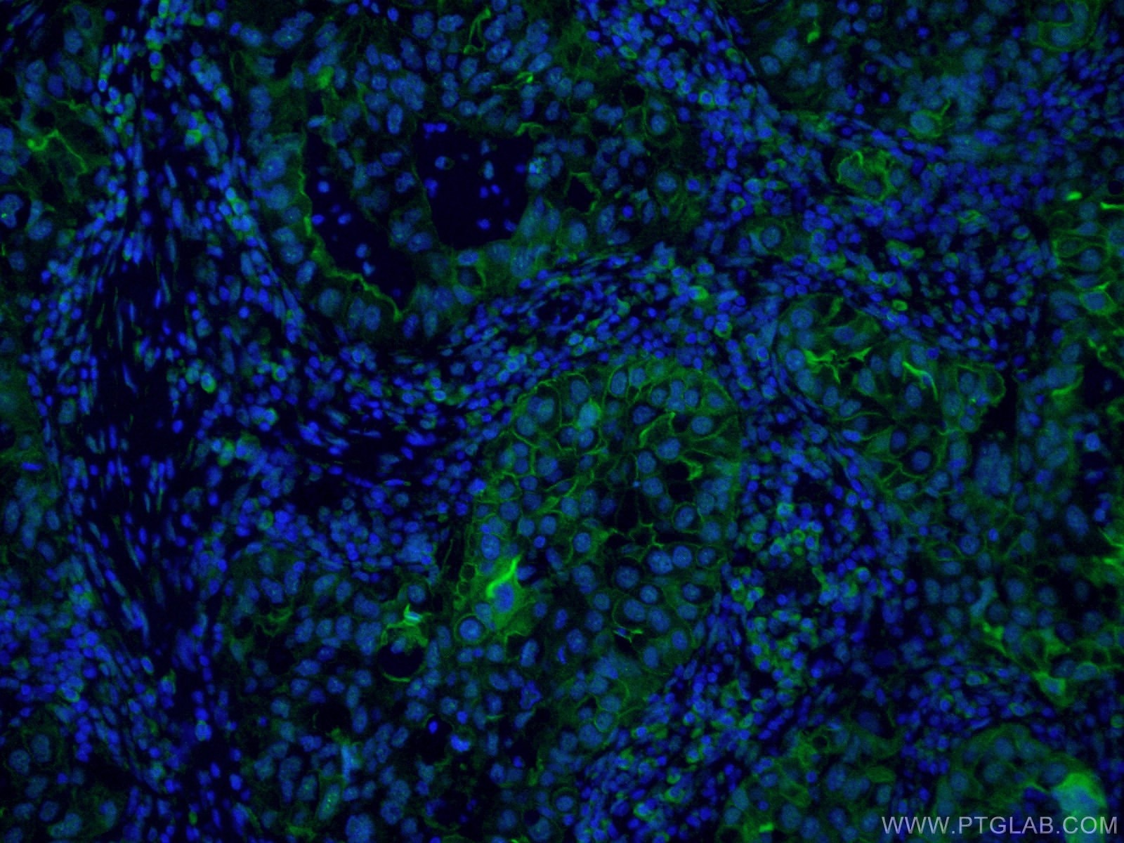 ICAM-1 Antibody IF human lung cancer tissue FITC-60299