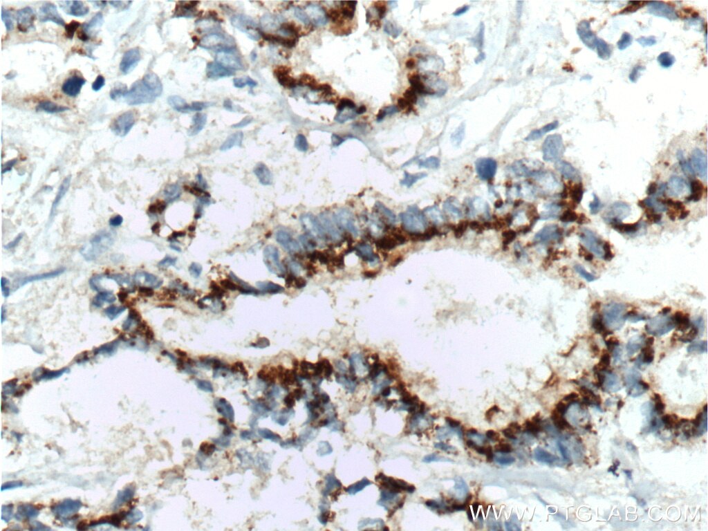 IL-10 Antibody IHC human pancreas cancer tissue 60269-1-Ig