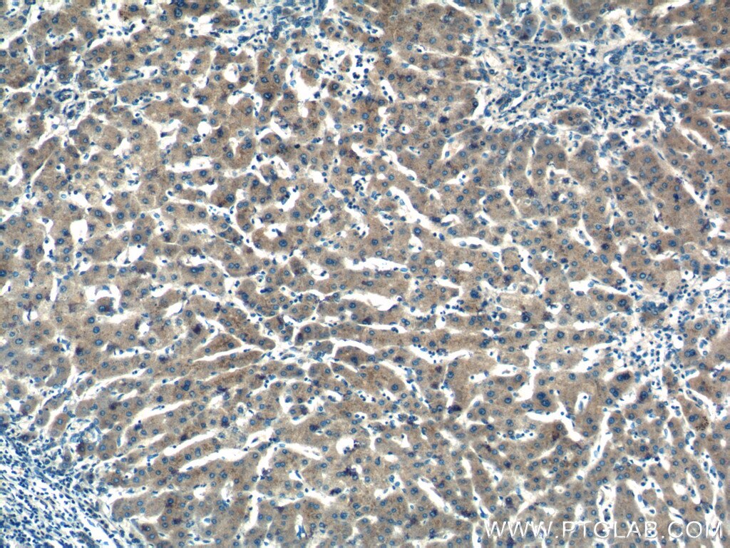 IL-6 Antibody IHC human hepatocirrhosis tissue 21865-1-AP