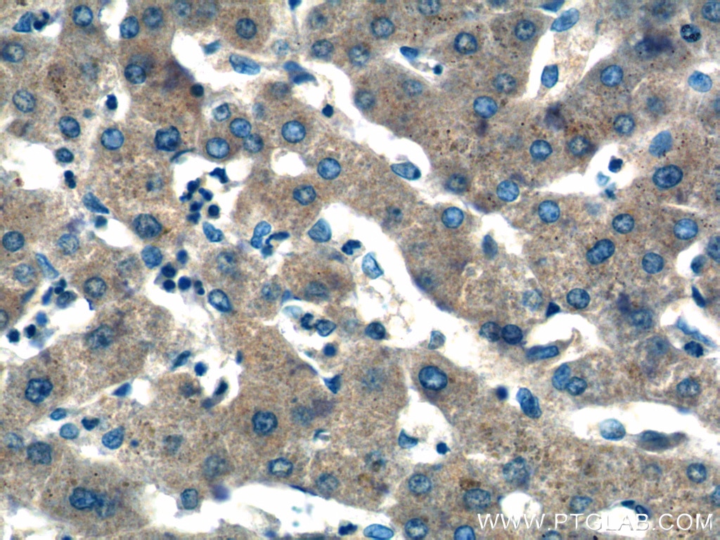 IL-6 Antibody IHC human hepatocirrhosis tissue 21865-1-AP