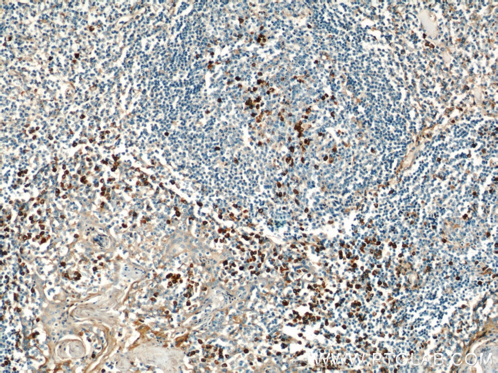IL-6 Antibody IHC human tonsillitis tissue 21865-1-AP