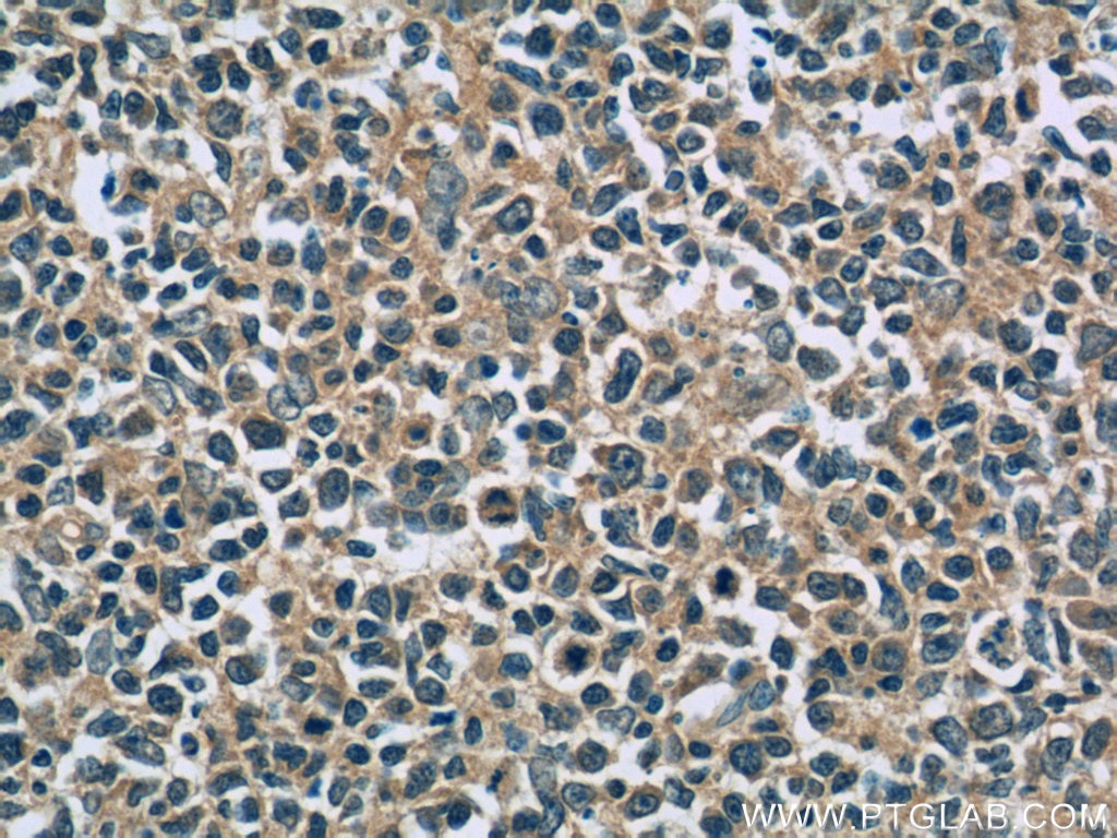 IL-6 Antibody IHC human tonsillitis tissue 66146-1-Ig