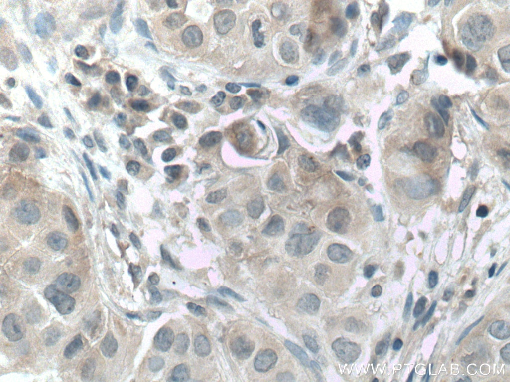 JAK2 Antibody IHC human breast cancer tissue 17670-1-AP