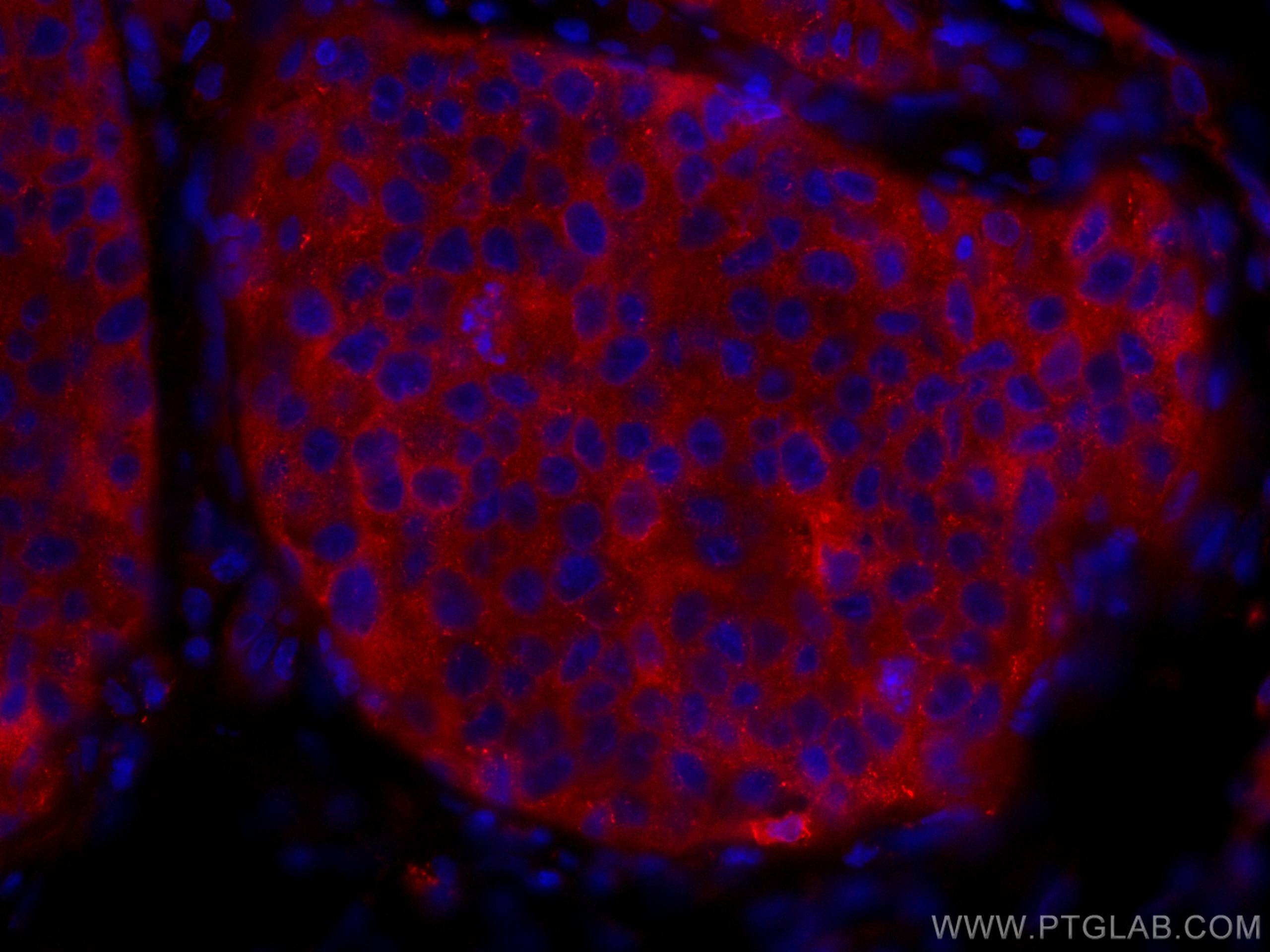 KEAP1 Antibody IF human breast cancer tissue CL594-10503