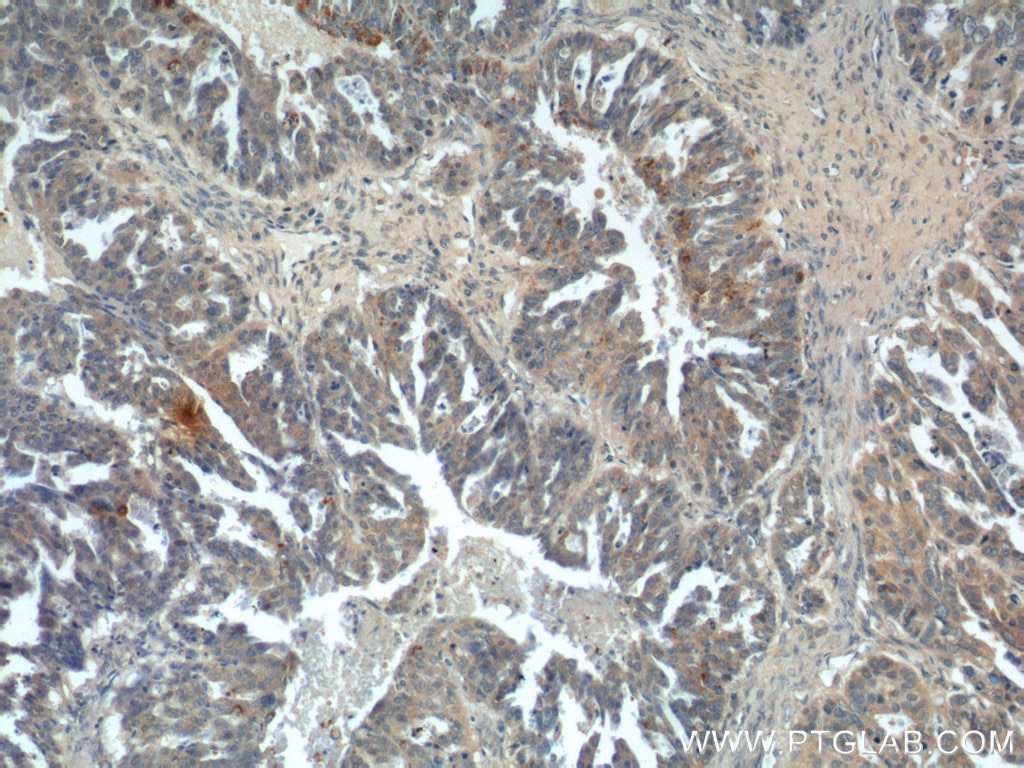 Kallikrein 8 Antibody IHC human ovary tumor tissue 14232-1-AP