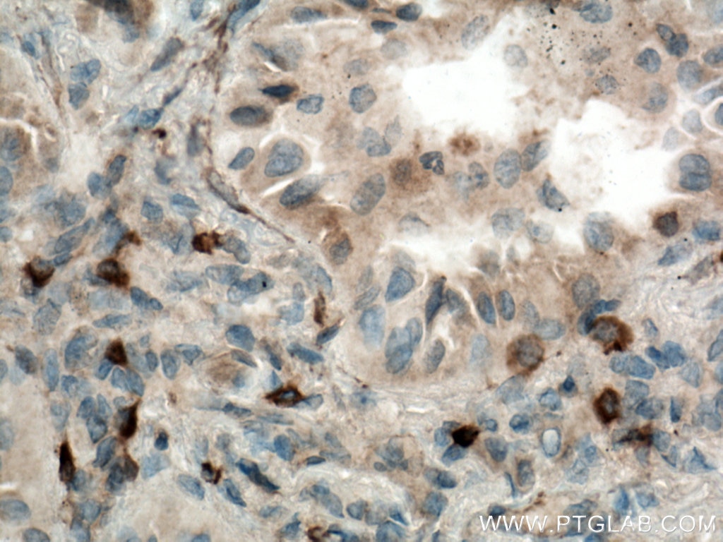 KRAS Antibody IHC human lung cancer tissue 12063-1-AP