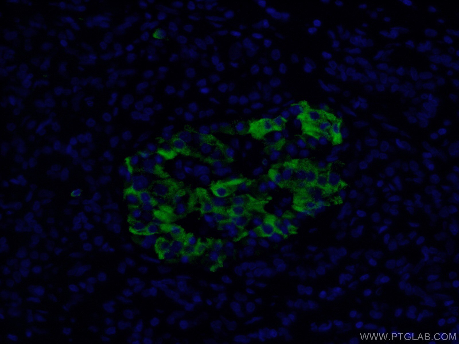 MMP7 Antibody IF human pancreas cancer tissue 10374-2-AP