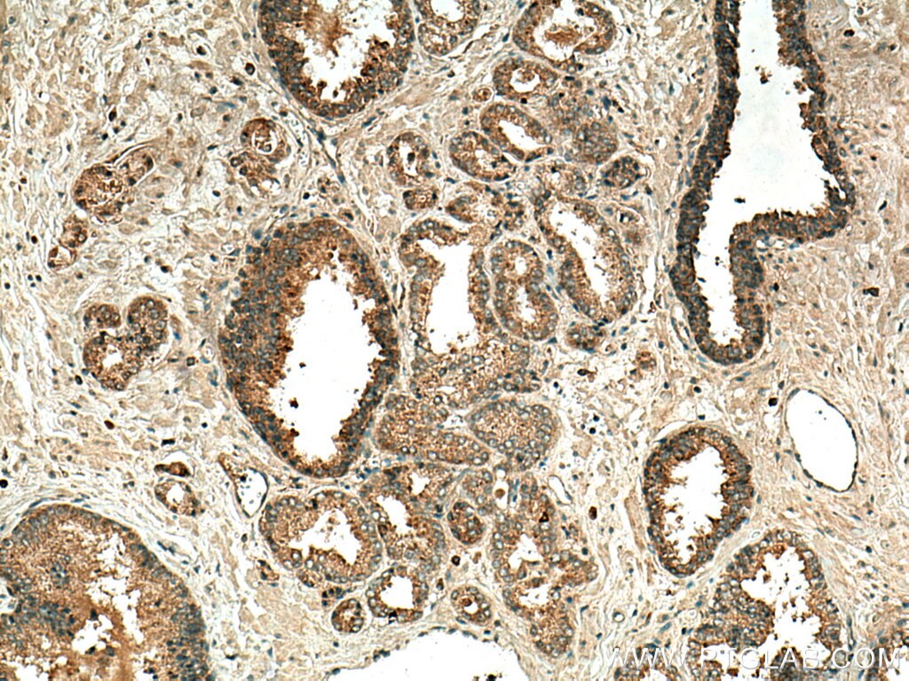 MMP7 Antibody IHC human prostate cancer tissue 10374-2-AP