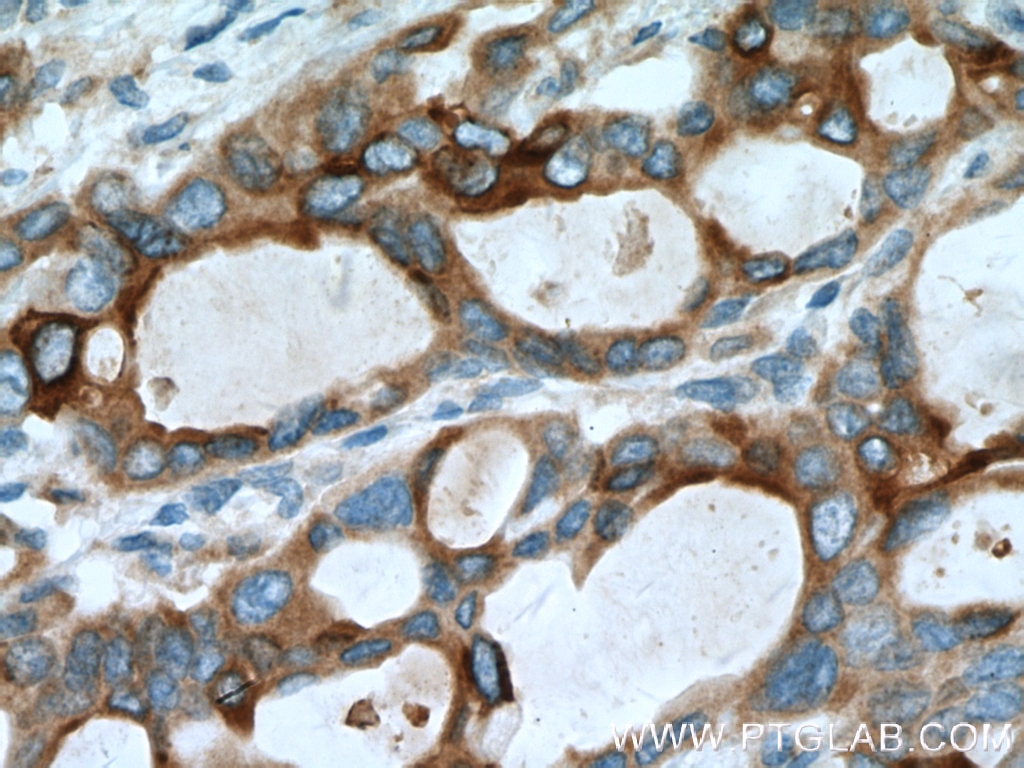 MMP7 Antibody IHC human pancreas cancer tissue 10374-2-AP