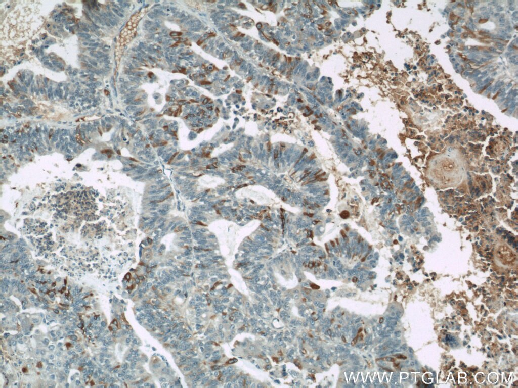 IHC of paraffin-embedded human ovary tumor using 60261-1-Ig (MUC16,CA125 antibody) at dilution of 1:50 (10x lens)