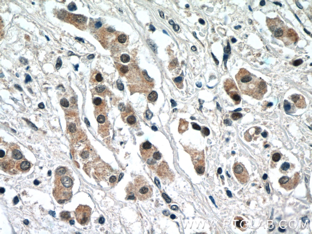 NRF2, NFE2L2 Antibody IHC human breast cancer tissue 16396-1-AP