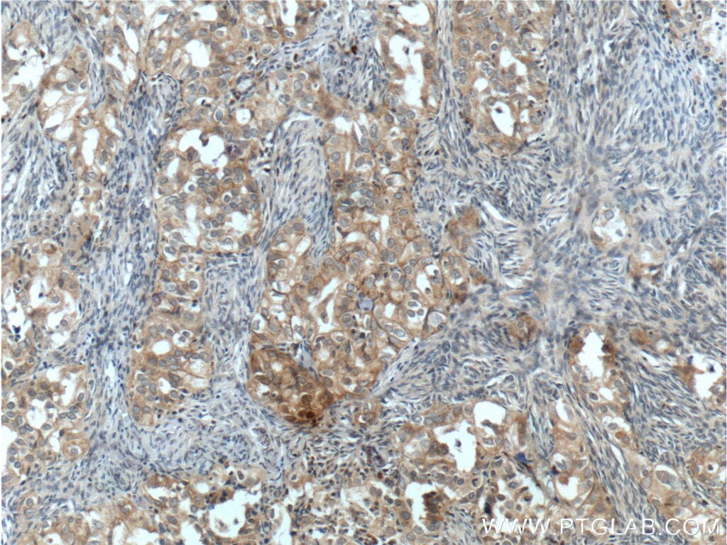 NRF2, NFE2L2 Antibody IHC human ovary tumor tissue 16396-1-AP