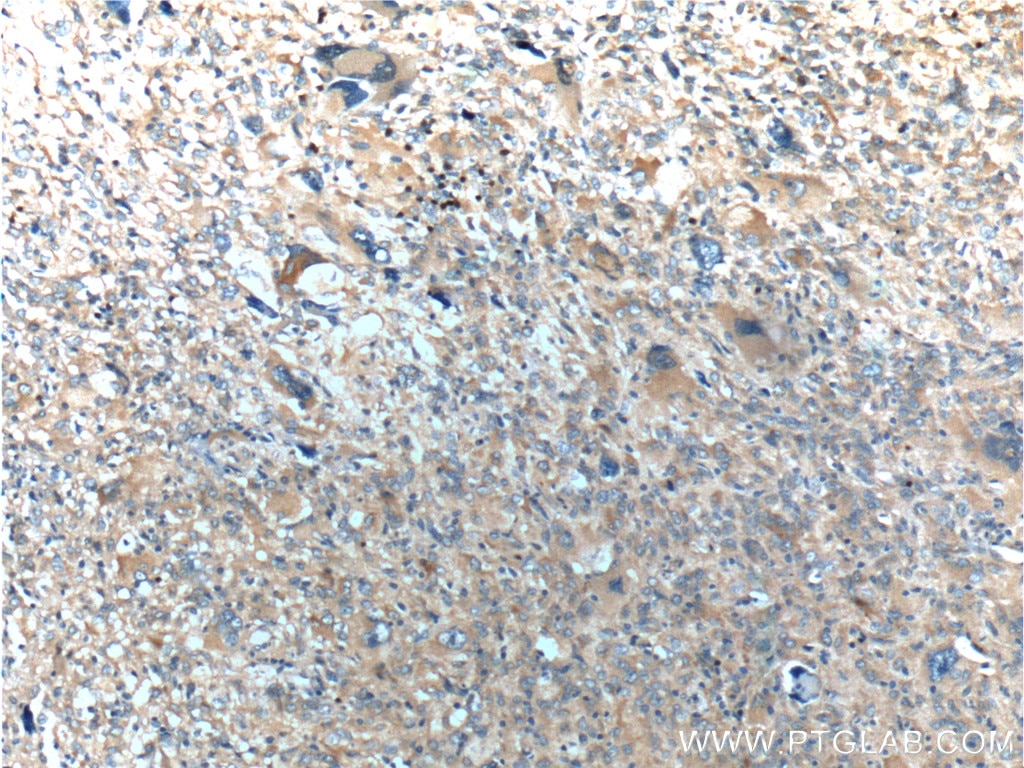 OPTN Antibody IHC human gliomas tissue 10837-1-AP