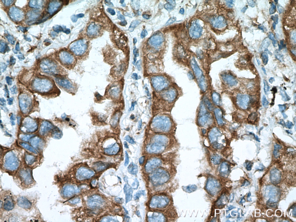 ERp57/ERp60 Antibody IHC human lung cancer tissue 15967-1-AP