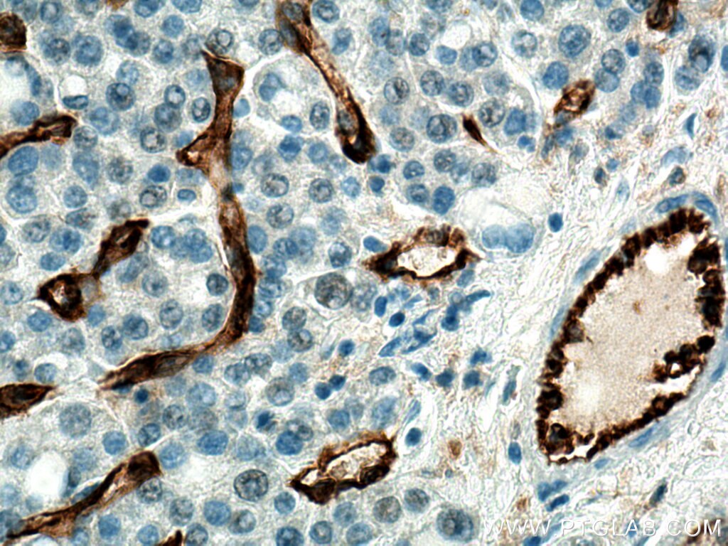 CD31 Antibody IHC human liver cancer tissue 11265-1-AP