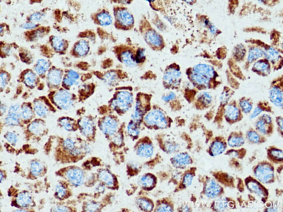 SOD2 Antibody IHC human liver cancer tissue 24127-1-AP