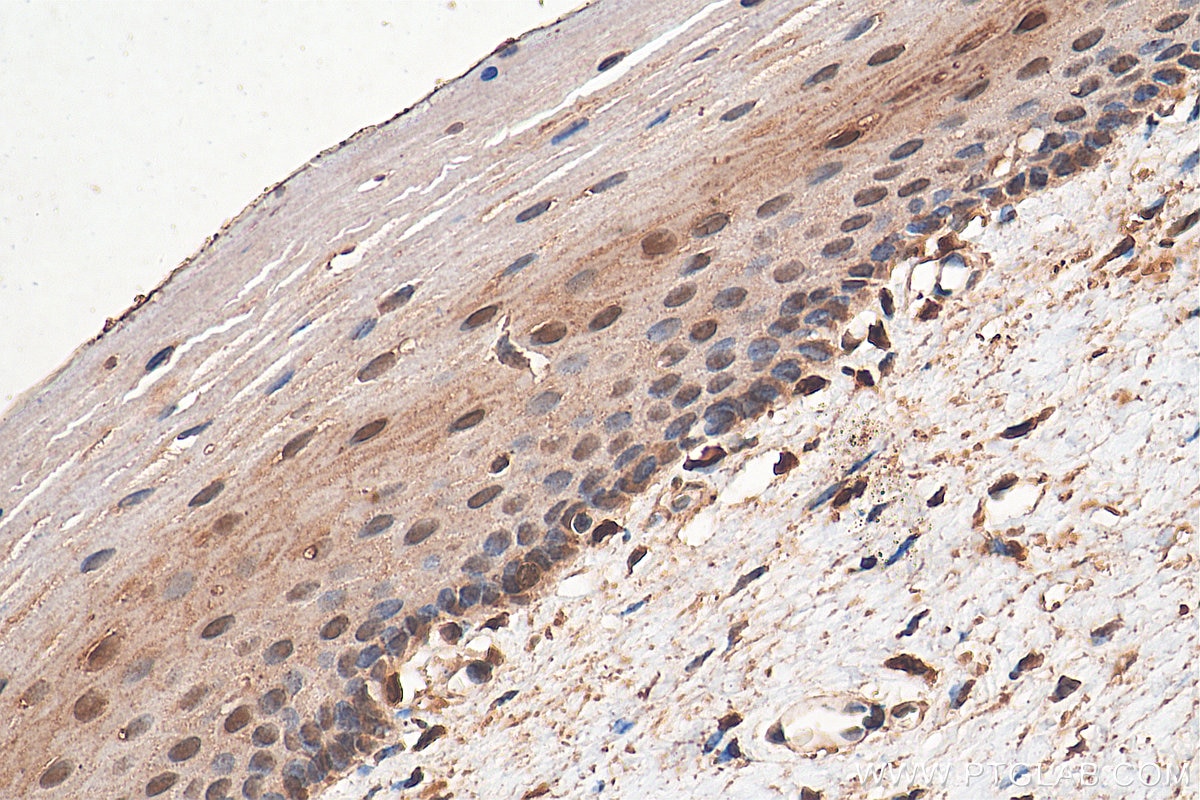 STAT3 Antibody IHC human cervical cancer tissue 10253-2-AP
